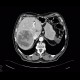 Hepatocellular carcinoma, HCC, gigantic: CT - Computed tomography